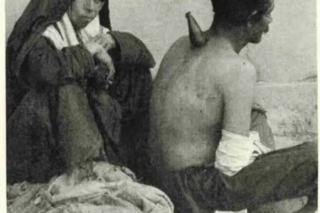 مرد قاجاری در حال حجامت شدن توسط یک زن / عکس